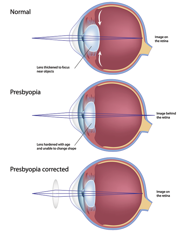 Riverside Presbyopia