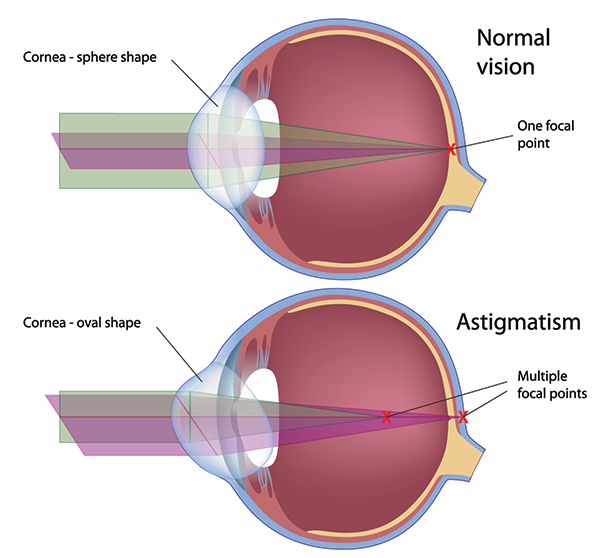 Old Greenwich Astigmatism