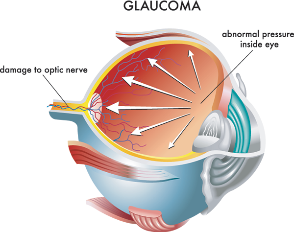 Old Greenwich Glaucoma