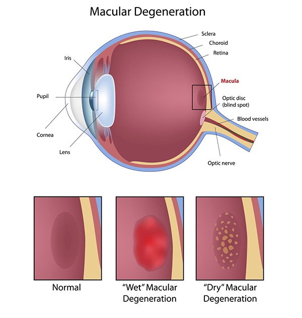 Old Greenwich Macular Degeneration