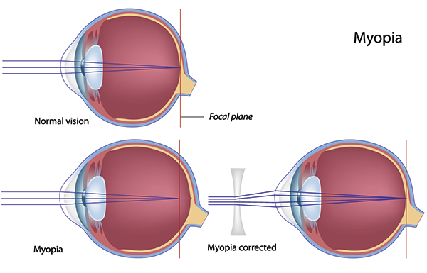 Riverside Nearsightedness